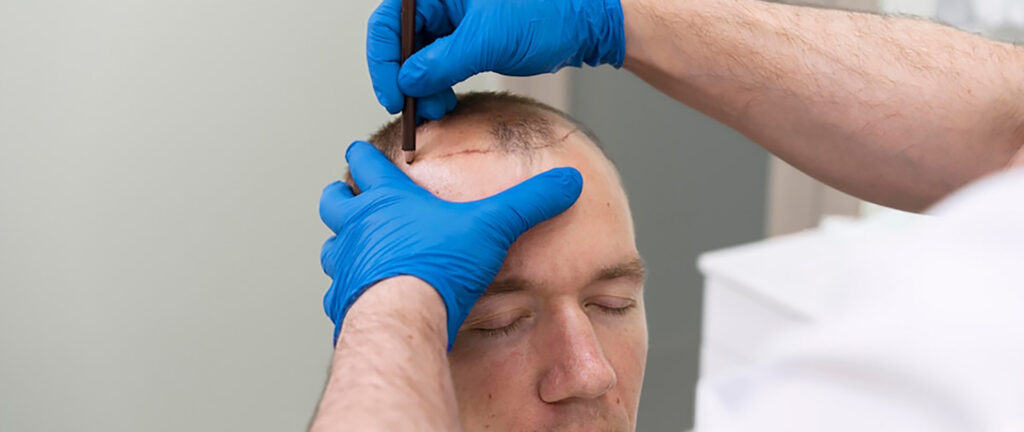 FUE vs. FUT: Which Hair Transplant Method is Best for You?