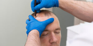 FUE vs. FUT: Which Hair Transplant Method is Best for You?