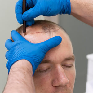 FUE vs. FUT: Which Hair Transplant Method is Best for You?